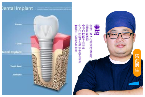 合肥种植牙哪家医院好