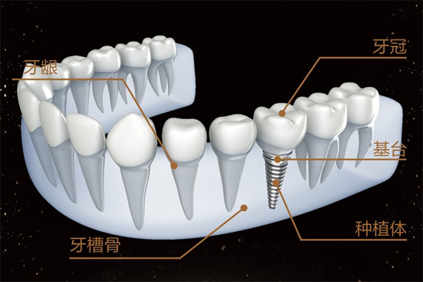 种植牙