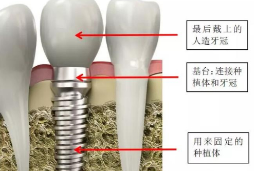 合肥种植牙价格表/要多少钱