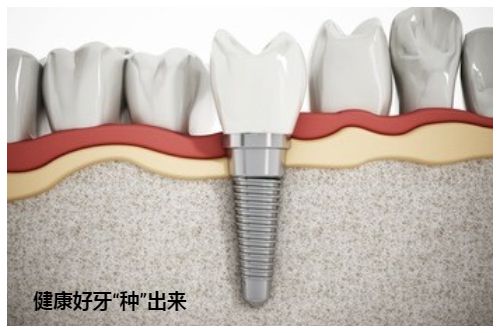 合肥种植牙