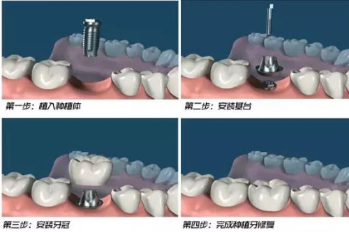 合肥口腔医院种植牙多少钱一颗