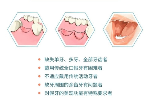 合肥种植牙多少钱一颗-想快速了解收费的看这里！